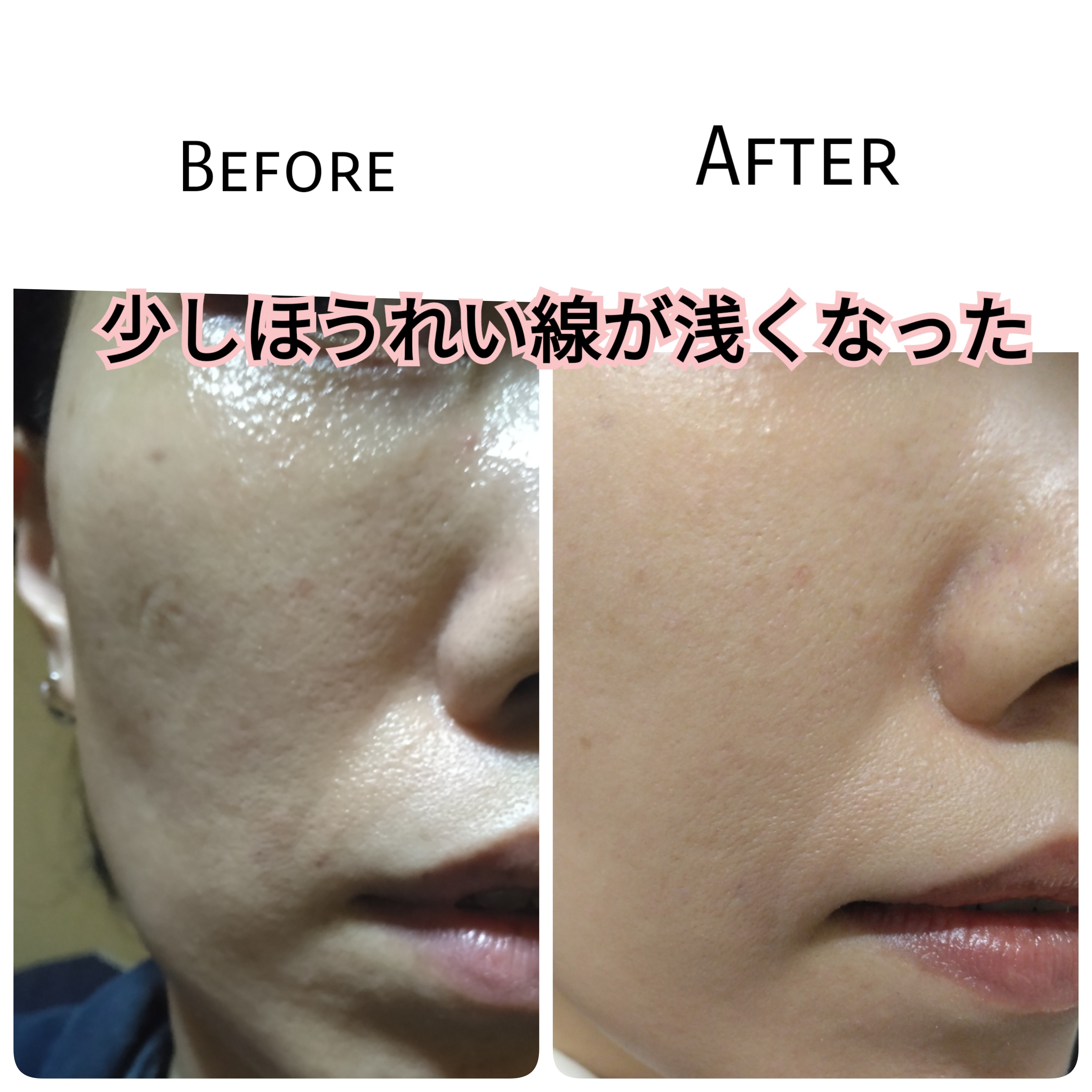 リンクルショットメディカルセラムN1ヶ月検証】以前より深くなったと