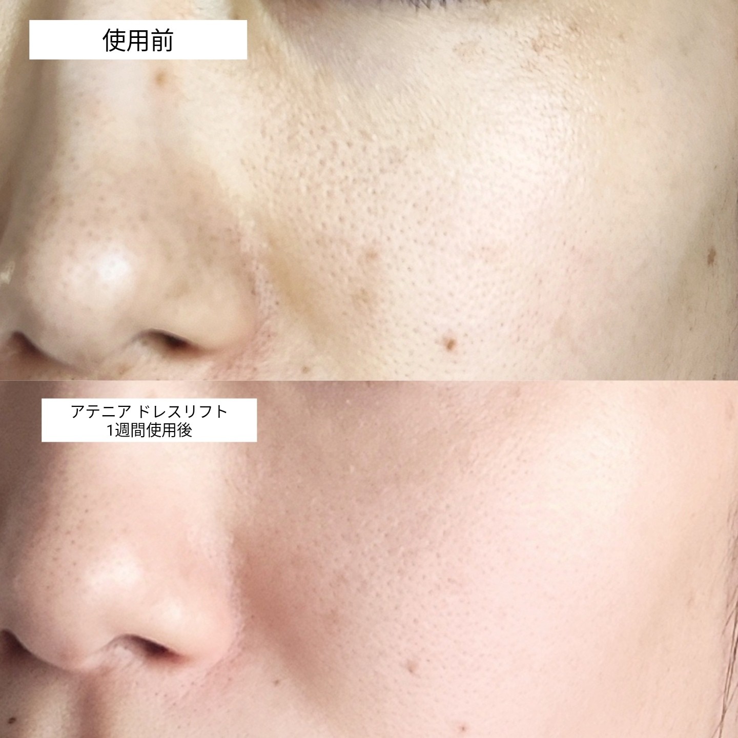 アテニア ドレスリフトのトライアルセットを1週間試した結果】ゆるみが