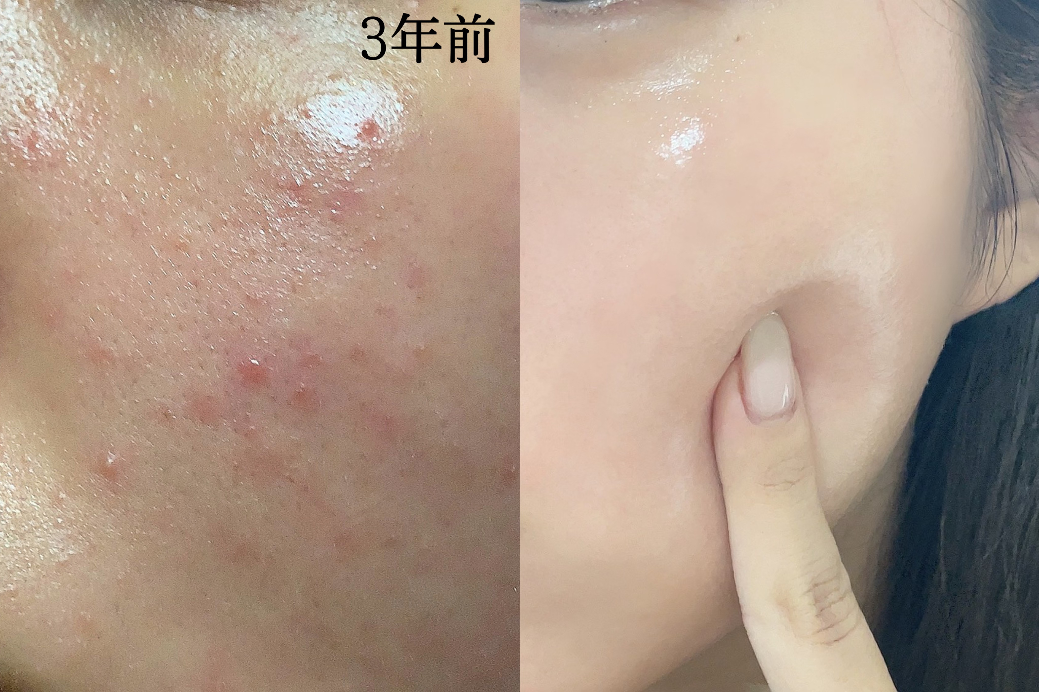 毛穴・ニキビ・シミ】美容皮膚科ナースが愛用してリアルに効果のあった 