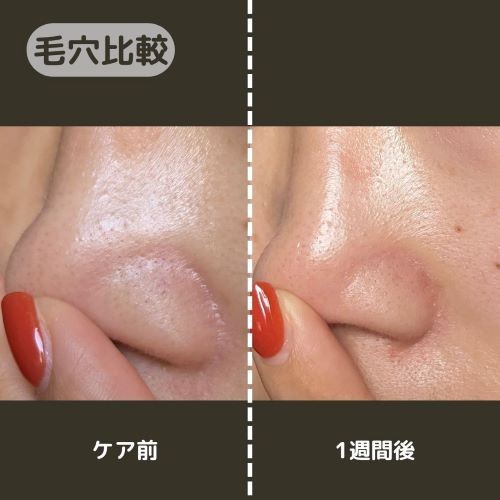 蒸しタオル 乳液 コレクション 角栓 黒ずみ