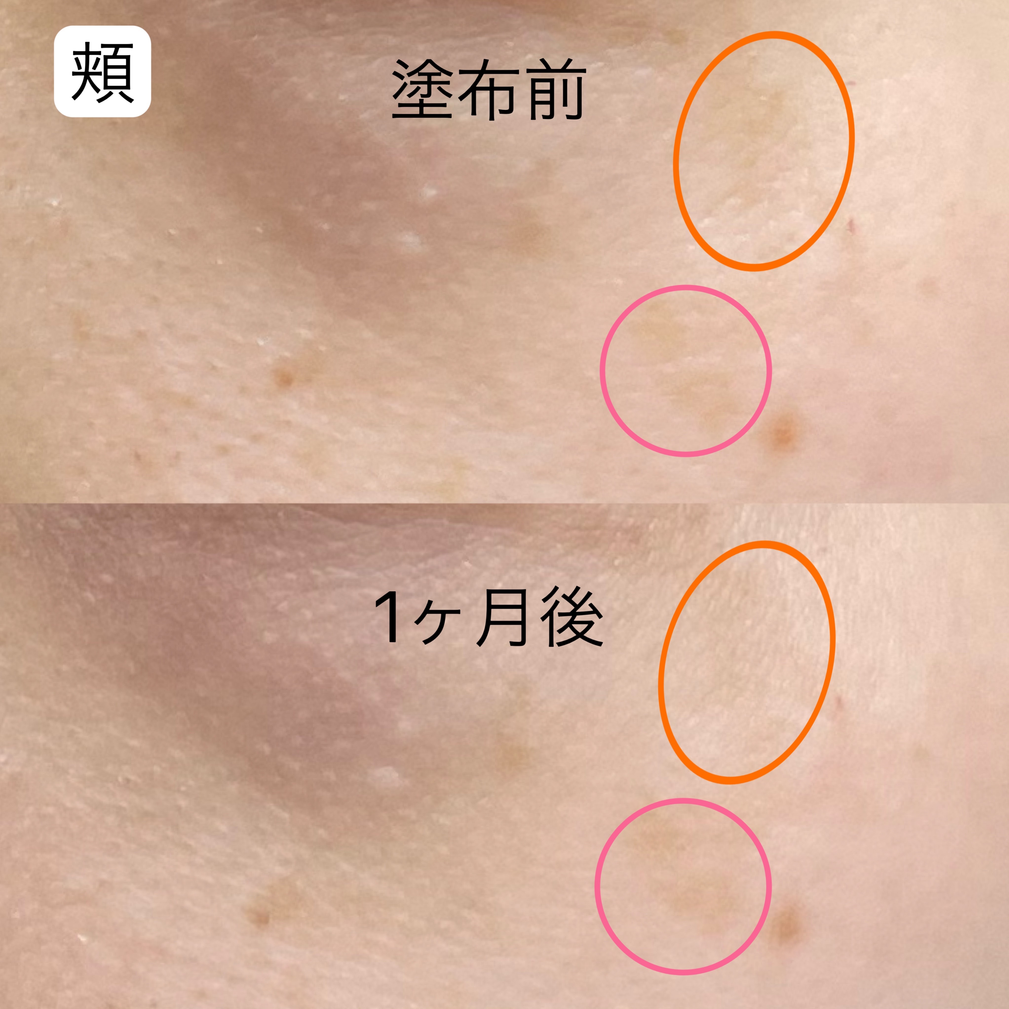 鼻のシミが改善された！合わない美白化粧品が多い私が1ヶ月でシミ消し 