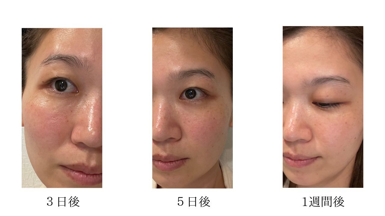 敏感肌アラサー美容ライターが自分史上1番のツルツル肌に】レチノール 