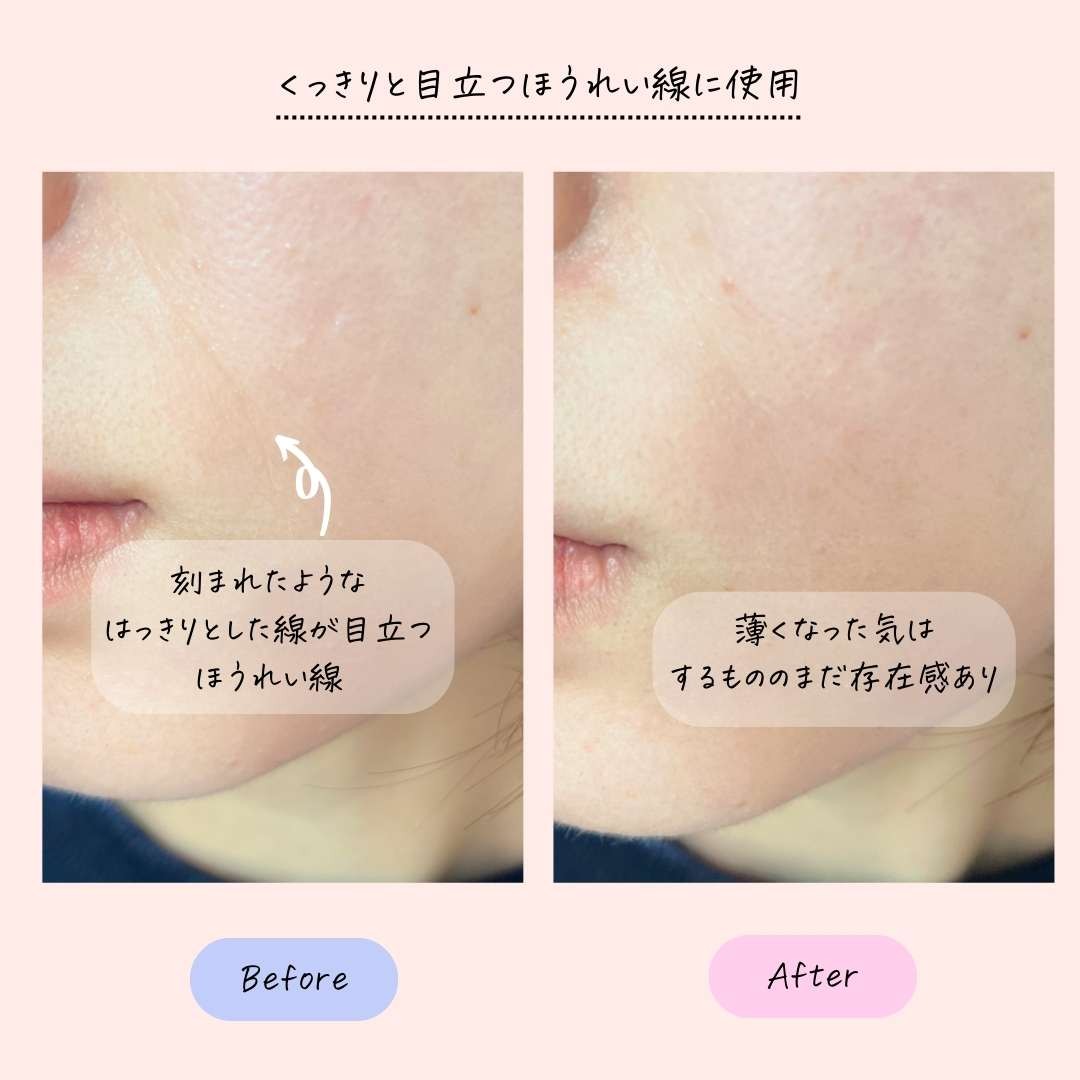 目元の小じわをくっきりとした真皮じわにさせない方法 [シワ