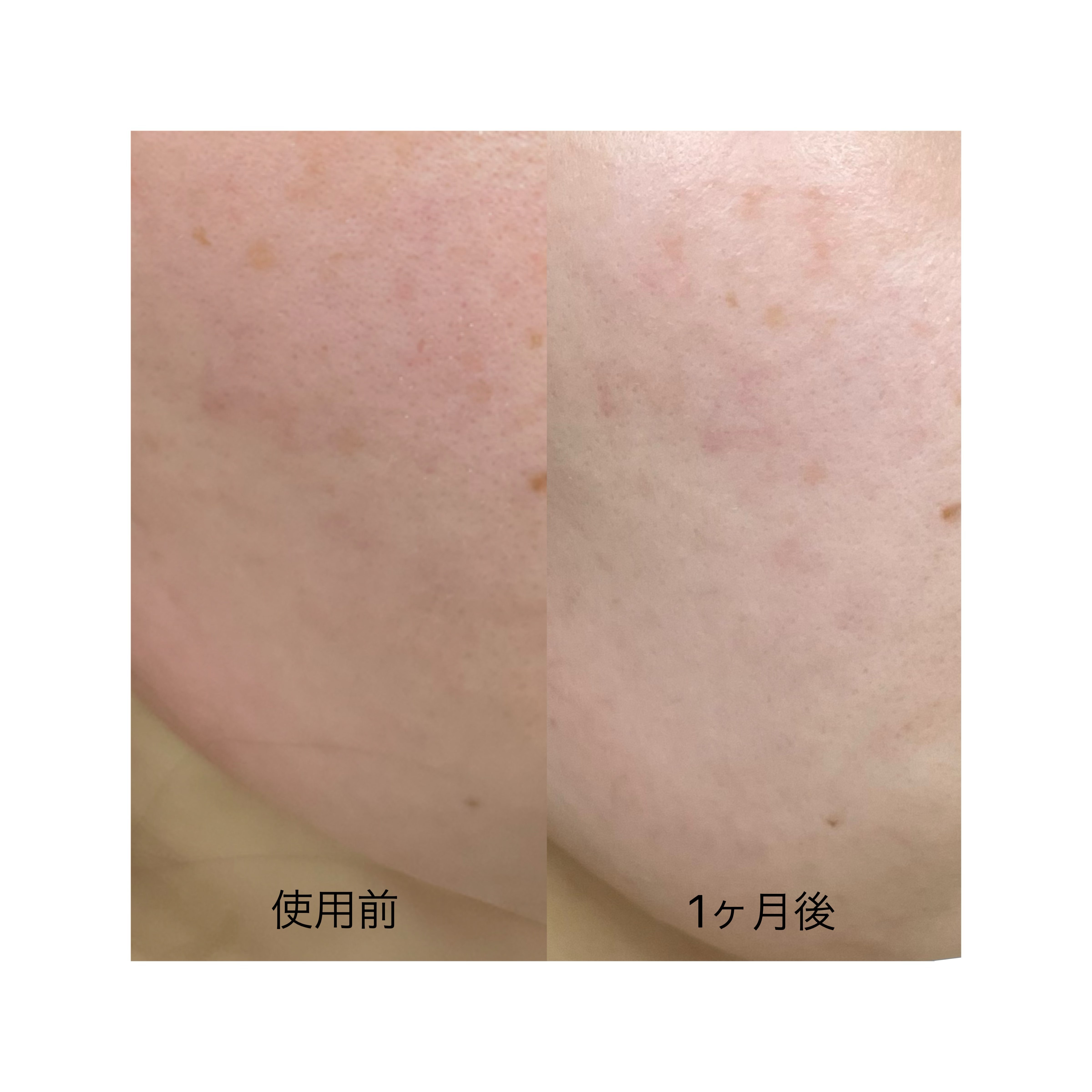 ゆらぎ肌さんにおすすめ】花粉症による肌荒れやくすみに悩んで