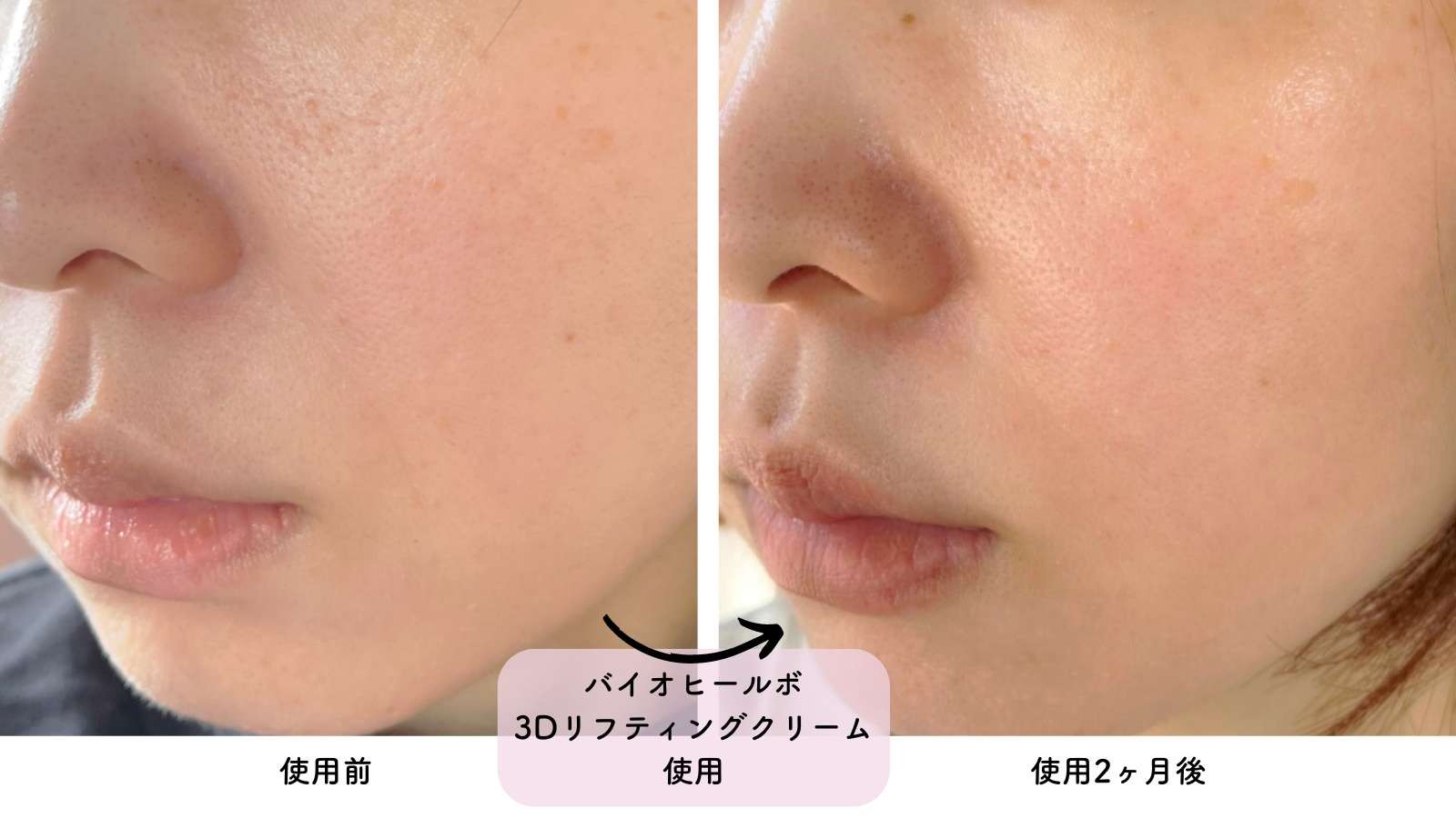 ハリを感じてリピートしたバイオヒールボ「タンタンクリーム」ほうれい線が気になる30代後半のしぼみ肌にふっくら感をプラスできた｜nene｜ONEcosme  レビュー